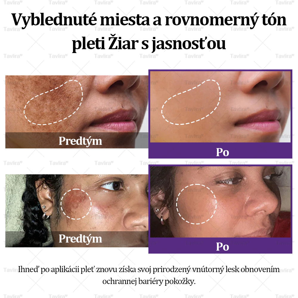 💜Tavlira® EPIGLOW MelanEX Prémiový krém proti hyperpigmentácii | ✅Schválené zdravotníckym oddelením Slovenska