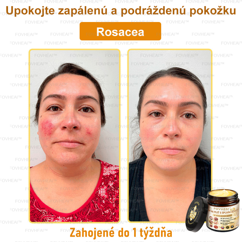 💎🐝💎FOVHEAl™ Krém na pleť s úplným účinkom z včelieho jedu - 🧑⚕️Odporúčané dermatológmi - Vhodné pre všetky vekové kategórie