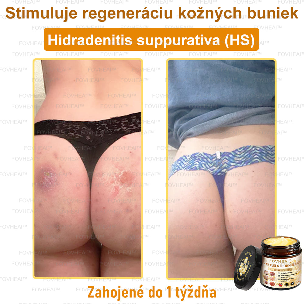 💎🐝💎FOVHEAl™ Krém na pleť s úplným účinkom z včelieho jedu - 🧑⚕️Odporúčané dermatológmi - Vhodné pre všetky vekové kategórie