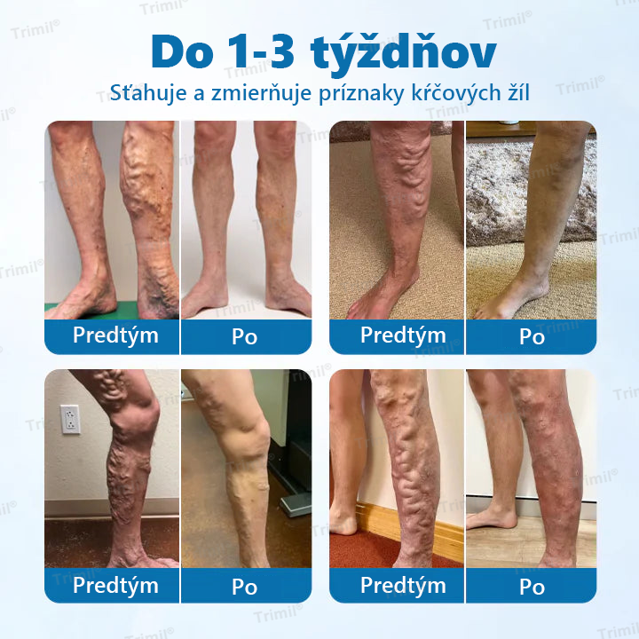💙Trimil® Bylinný Sprej na Ochranu Žíl - ✅ Klinicky preukázané: Kŕčové žily zmiznú už za 7 dní!